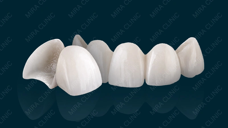 No-prep veneers